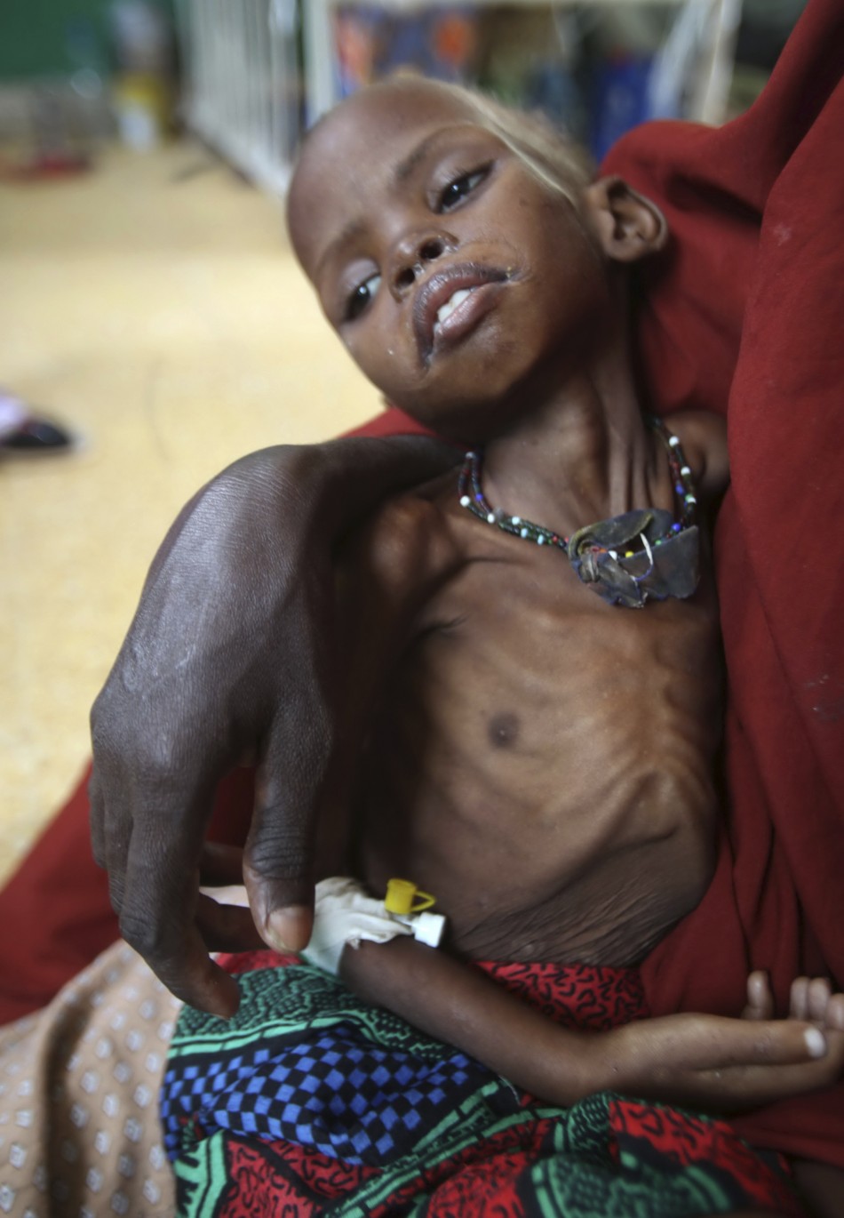132838-millions-of-malnourished-children-in-horn-of-africa-are-at-risk-of-dyi1.jpg